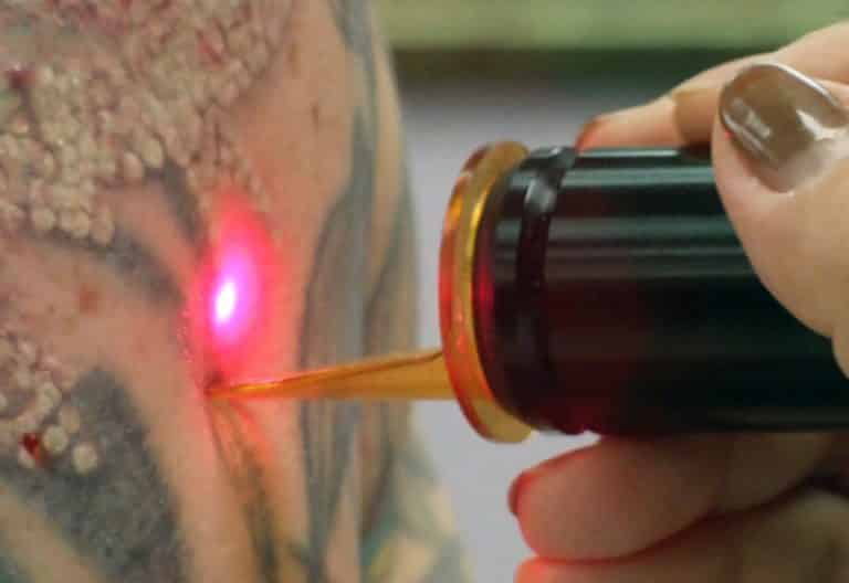 Effective Home Remedies To Remove Tattoo Safely